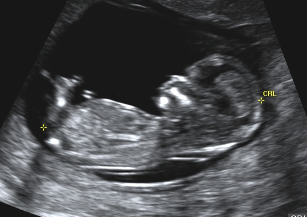 Twin babies ultrasound image.