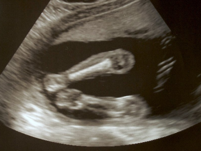 Baby Ultrasound PNG - 164128