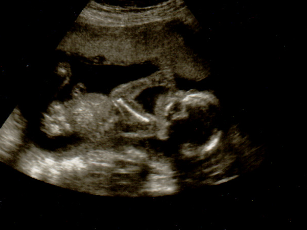 Baby Ultrasound PNG - 164126