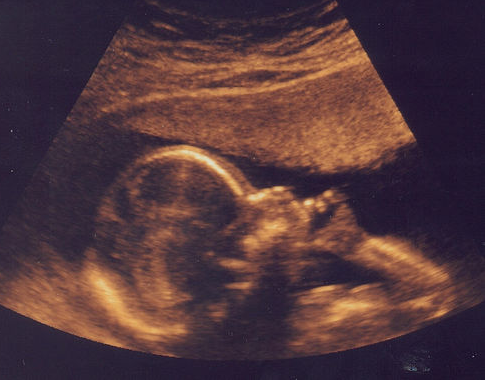 Baby Ultrasound PNG - 164113