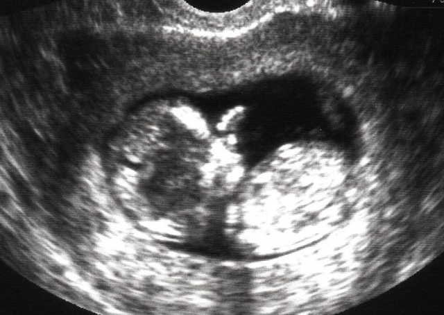 Baby Ultrasound PNG - 164125