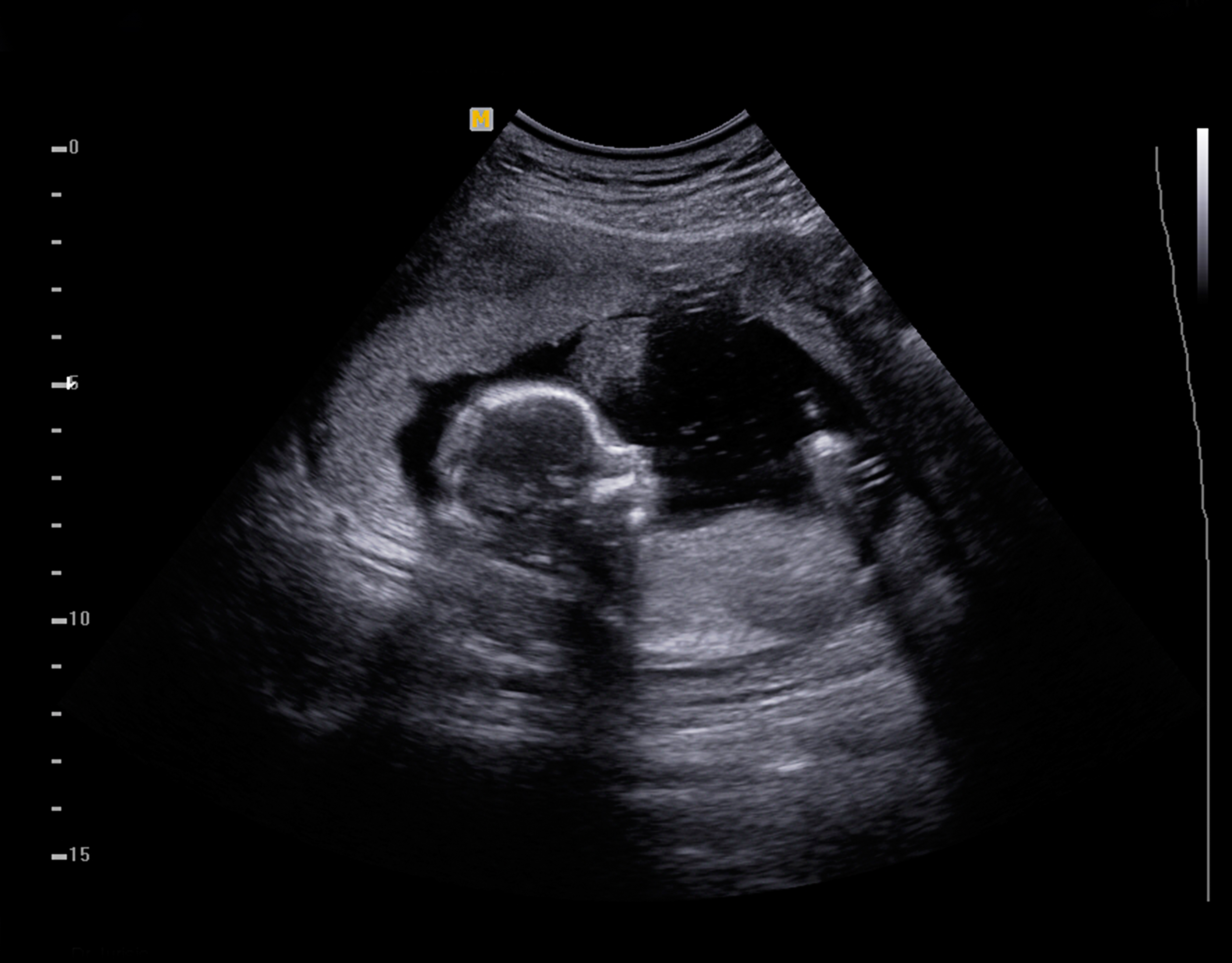 3D Ultrasound and 4D Ultrasou