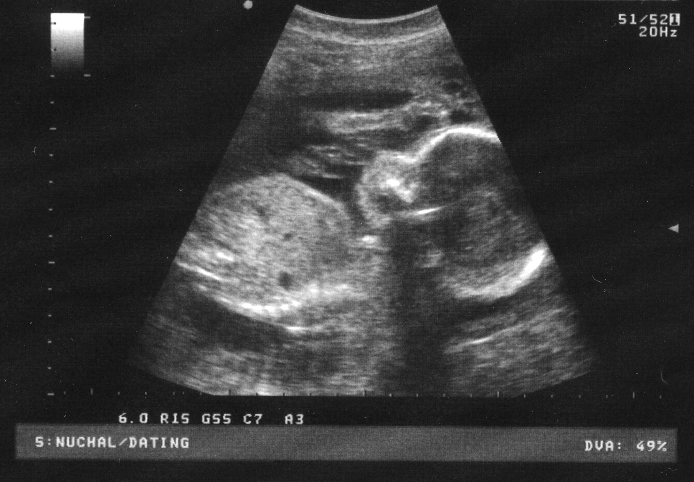 Baby Ultrasound PNG - 164114