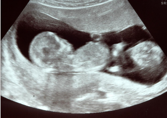 Baby Ultrasound PNG - 164115