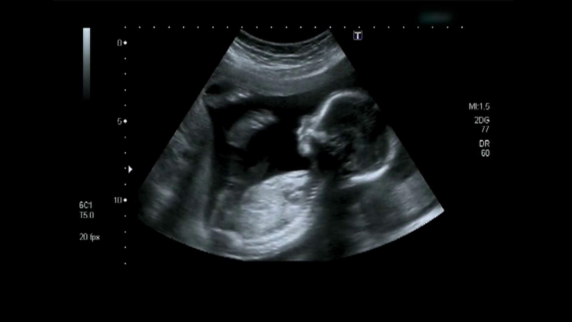 Baby Ultrasound PNG - 164123