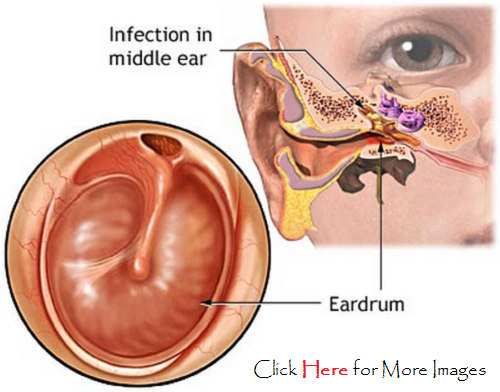 Ear Infection PNG - 170537