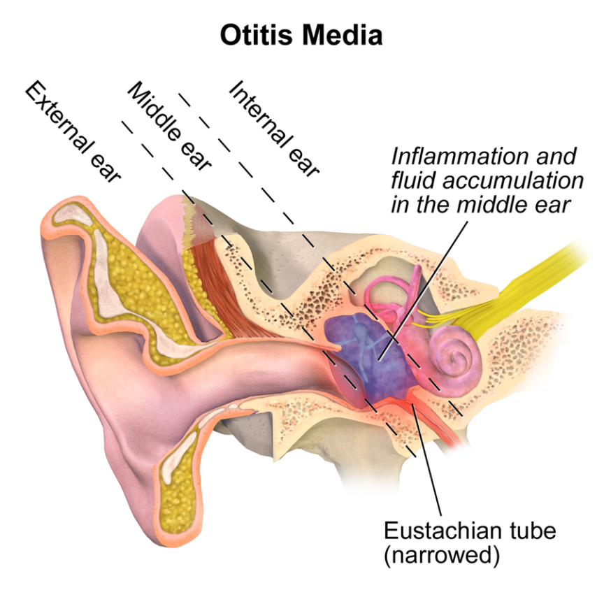 Ear Infection PNG - 170529