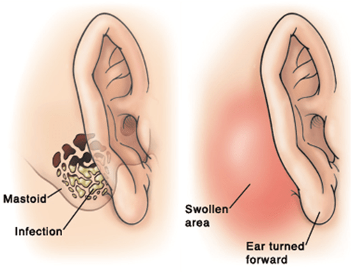 Ear Infection PNG - 170535