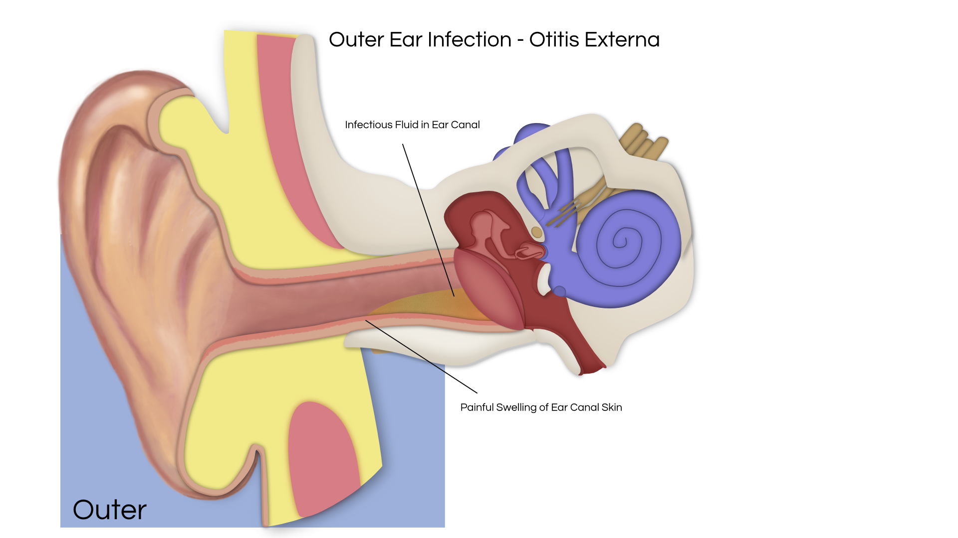 Ear Infection PNG - 170540