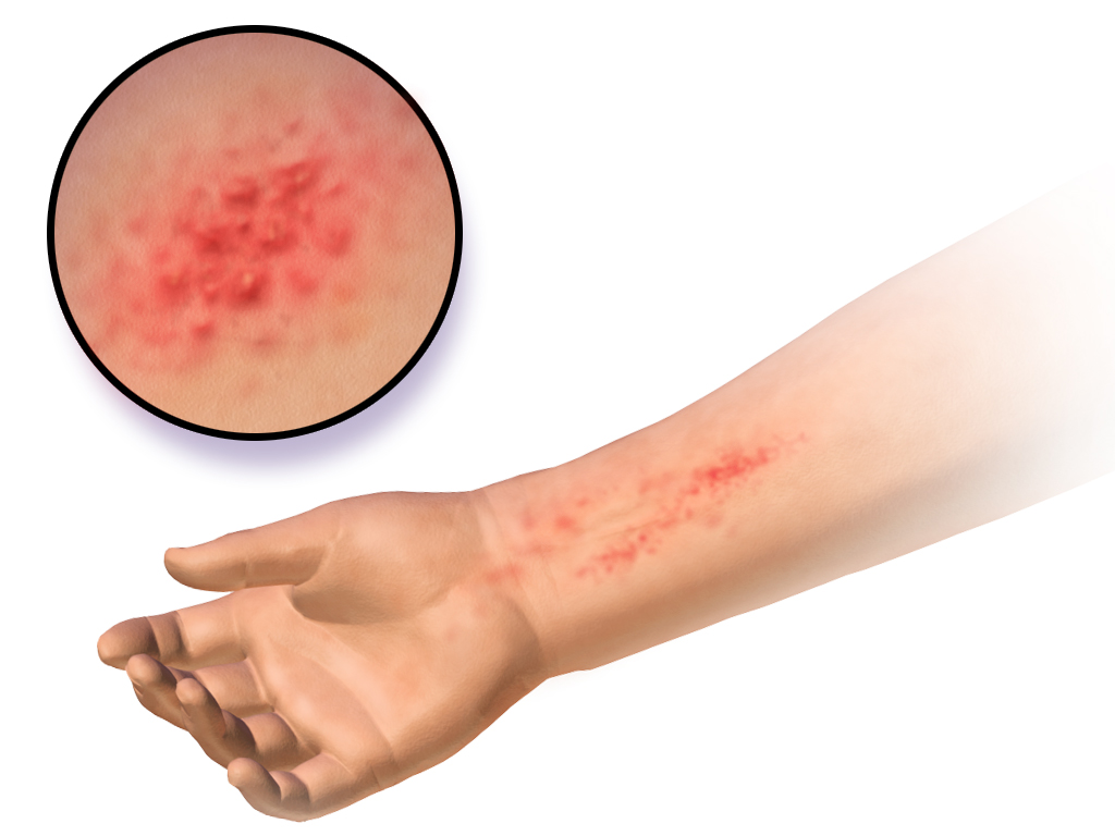 Eczema PNG - 134044