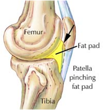 Fat Woman With Knee Pain PNG - 165494