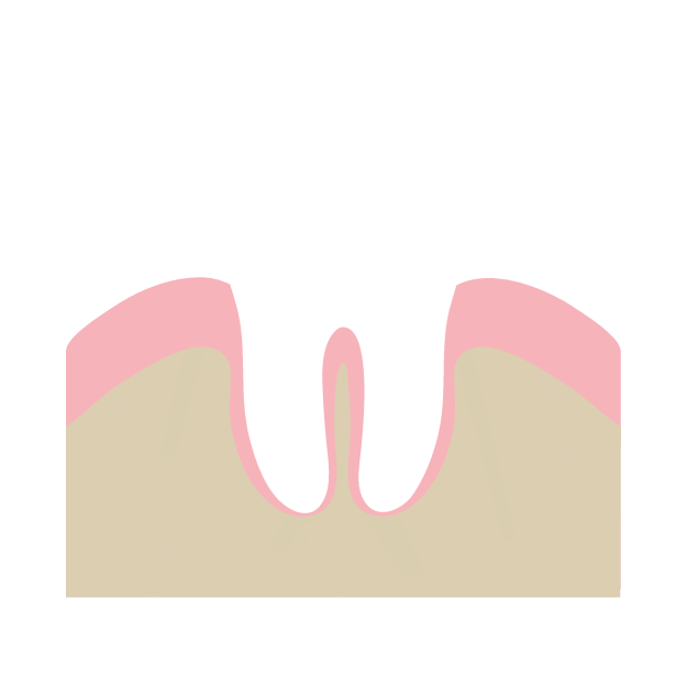 Gesunder Zahn - Zahnfleischen