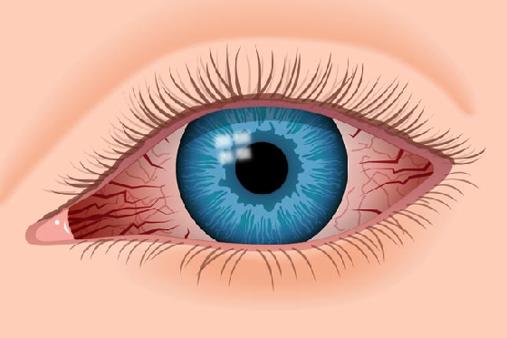 VISINE A.C.® Ultra Itchy Eye