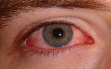 Causes of itchy swollen eyes