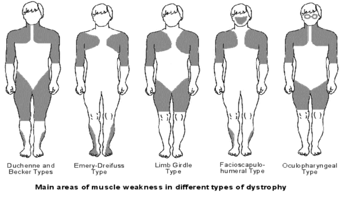 Muscular Dystrophy PNG - 64021
