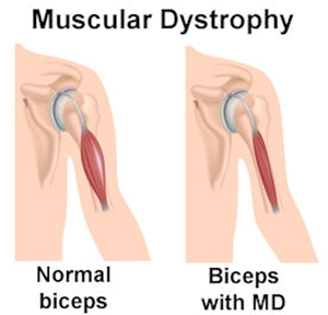 What is Muscular Dystrophy ?
