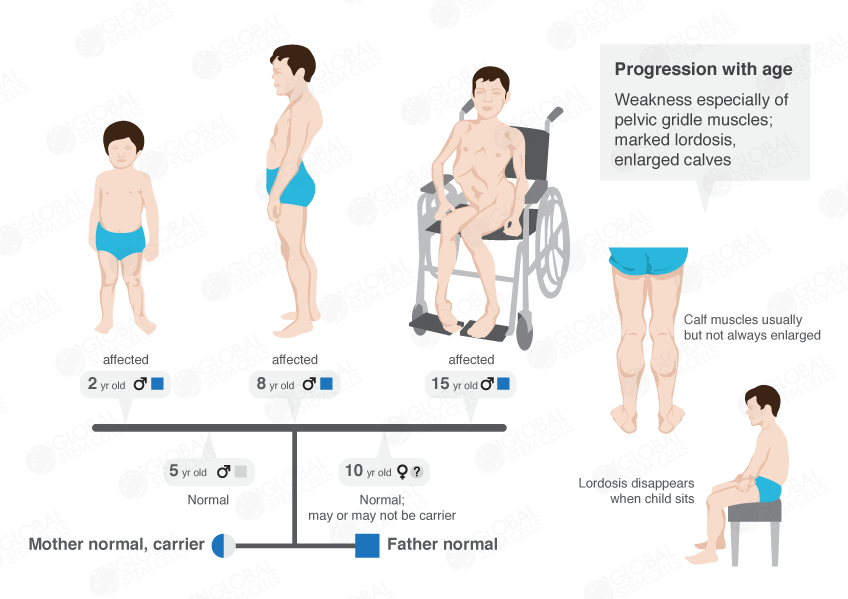 Muscular Dystrophy PNG - 64017