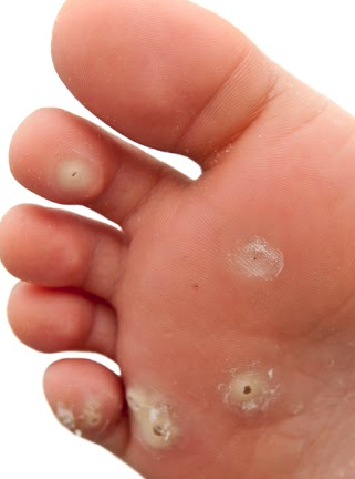 Warts are caused by a DNA vir