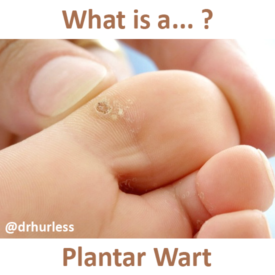 Planters Wart PNG - 164683