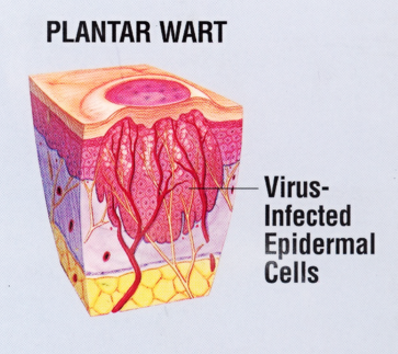Planters Wart PNG - 164685