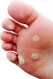 Plantar warts are a special t