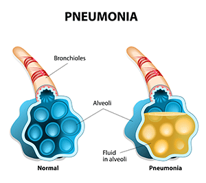 Pneumonia u0026 CVD: Making t