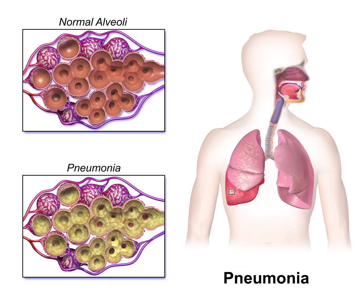Pneumonia is an infection of 