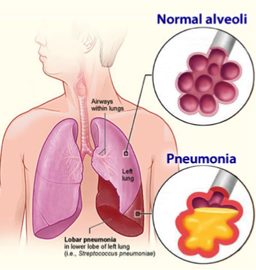 Pneumonia Patient PNG - 76742