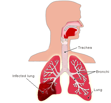 Pneumonia is an infection of 