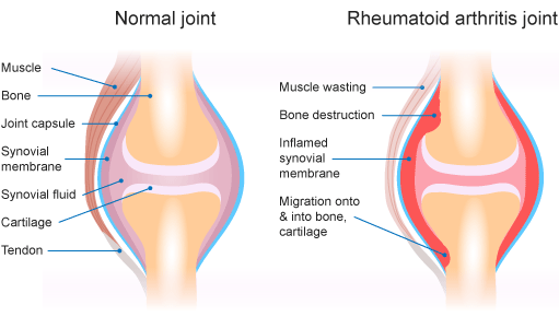 Rheumatism PNG - 76190