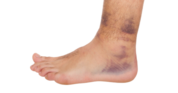 Sprained Ankle PNG - 64495