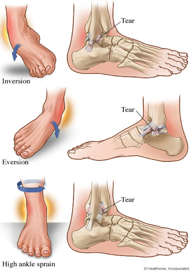 Sprained Ankle PNG - 64502