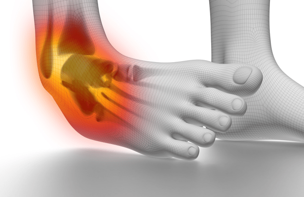 Sprained Ankle PNG - 64503