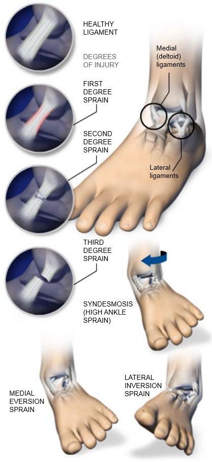 Sprained Ankle PNG - 64507