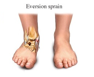 Sprained Ankle PNG - 64506