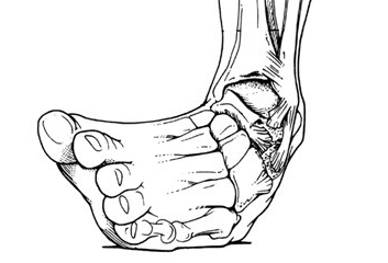 Sprained Ankle PNG - 64499