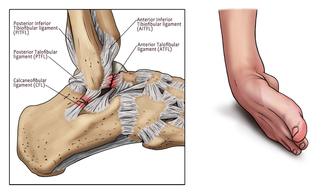 Sprained Ankle PNG-PlusPNG.co