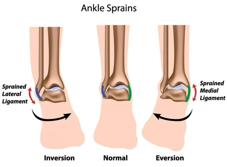 Sprained Ankle PNG - 64504
