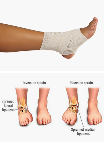 Sprained Ankle PNG - 64500