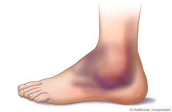 Sprained Ankle PNG - 64498