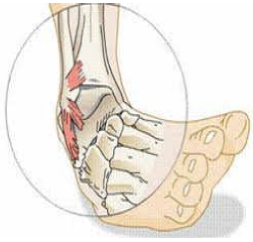 Sprained Ankle PNG - 64493