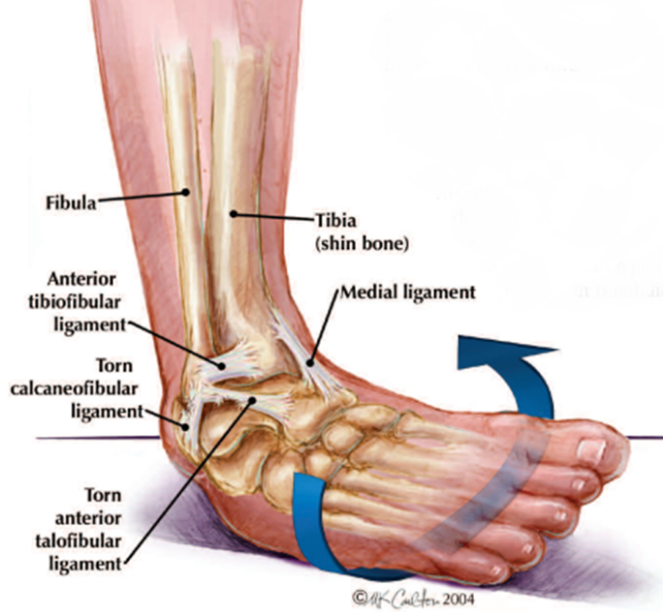 Sprained Ankle PNG - 64496