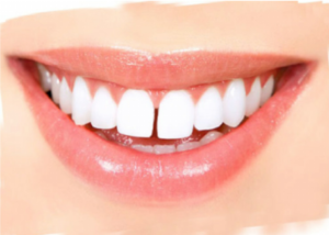 Tooth Gap PNG - 132627