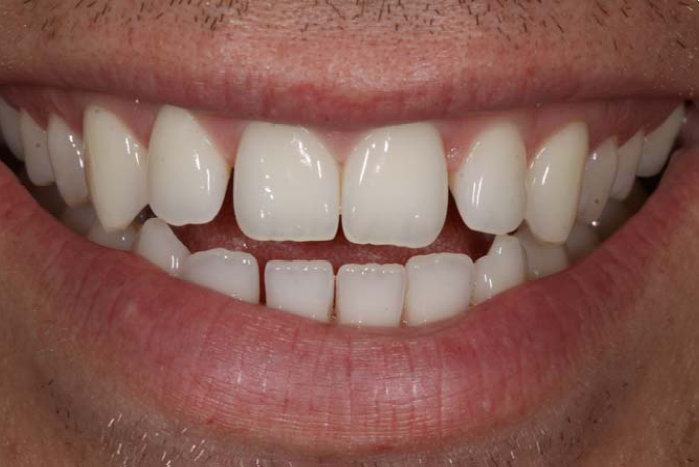 Tooth Gap PNG - 132623