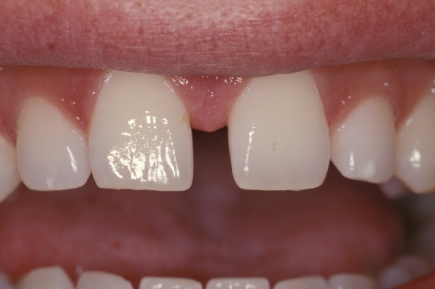 Gap Closure And Missing Tooth