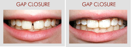 gap tooth smile plano tx cosm