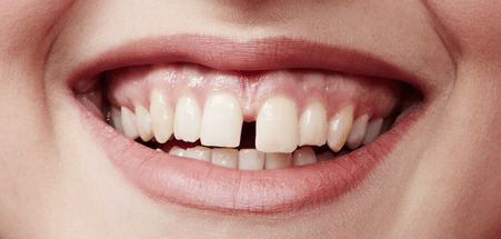 Tooth Gap PNG - 132626