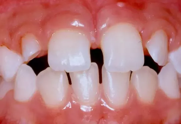 teeth gaps. This is very comm