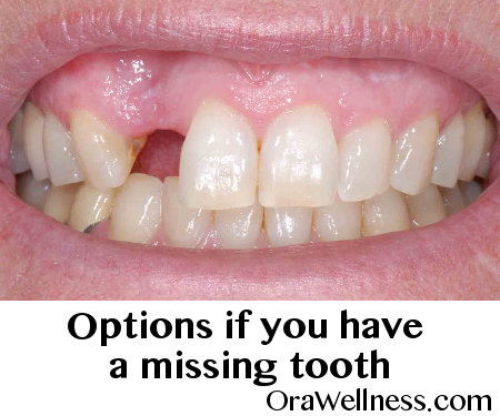 Tooth Gap PNG - 132625