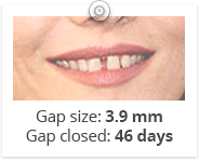 Tooth Gap PNG - 132624